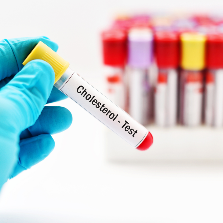 Fiolka z żółtym zamknięciem z napisem: Cholesterol Test trzymana w ręce z nałożoną rękawiczką. W tle wiele fiolek.